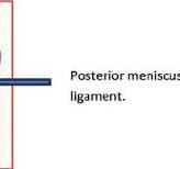 Posterior menisco-femoral ligament. | Download Scientific ...
