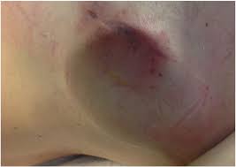 Icd placements that are reimbursed by the centers for medicare and medicaid services are entered into a. Pocket Infection As A Complication Of A Subcutaneous Implantable Cardioverter Defibrillator International Journal Of Cardiology
