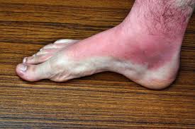 You may also have blood clot in leg without any of the common blood clot symptoms.you need to be very careful not to dismiss your symptoms even you have onset of blood clot symptoms in leg after getting a diagnosis of cancer. 10 Warning Signs Of A Blood Clot That Can T Be Ignored