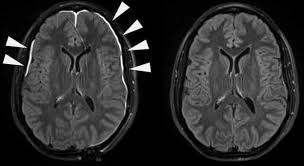 Image result for Brain Lesion