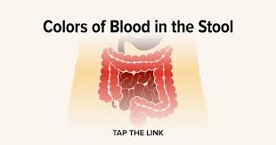 Image result for Blood in stool