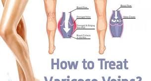 Pin On Varicose Veins Remedies