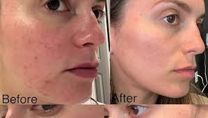 Amazon.com: Dr. Dennis Gross Skincare Alpha Beta Extra Strength Daily Peel 