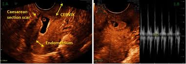 Cara matri wajan yg retak : Cesarean Scar Pregnancy Findings In Initial Cesarean Scar Pregnancy A Transv Open I The Aim Of The Present Study Was To Krishnah Ovary