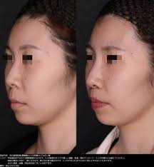 鼻の下を短くするには？切らないで人中を短くする方法はある？│SELECT CLINIC TIPS