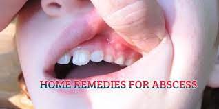 Pin On Abscess Tooth