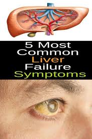 5 Most Common Liver Failure Symptoms Liver Failure Symptoms Liver Failure Healthy Advice