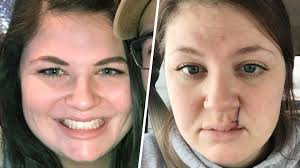 It affects people of all races, genders and ages, which is why it's absolutely critical for americans to learn about. Woman 26 With Basal Cell Carcinoma Writes Message To Teenage Self