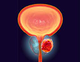 What causes prostate cancer is uncertain, but there are known risk factors, such as age or inherited genetic when prostate cancer is caught early, treatments can cure the disease. Aggressive Prostate Cancer Metastasis Mechanisms Uncovered