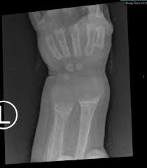 Image result for Rickets