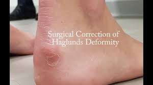 Surgical treatment for haglund's deformity. Surgical Correction Of Haglund S Deformity Youtube