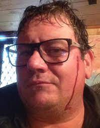 James glindemann, 68, says he was eating lunch at a park in sale, in victoria's gippsland region, when the bird began to swoop. Magpie Attack Narrowly Misses Man S Eye The Singleton Argus Singleton Nsw