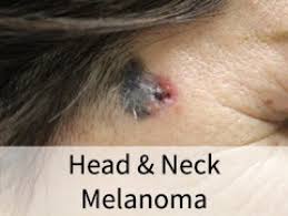 In the united states, it's estimated that doctors diagnose over 100,000 new skin cancer cases each year. Head Neck Skin Cancer Head Neck Surgery Stanford Otolaryngology Head Neck Surgery Ohns Stanford Medicine