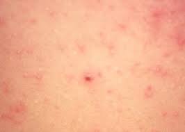 Image result for skin rash similar to scabies