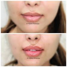 Unfortunately, as we grow older, both the natural production of hyaluronic. Lip Fillers In Mumbai Cost Before After Discount Lip Augmentation