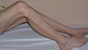 Aug 29, 2020 · the principle of use/disuse implies that when it comes to fitness, you do actually use it or lose it. this simply means that your muscles hypertrophy with use and atrophy with disuse. Muscle Atrophy Causes Symptoms And Treatments