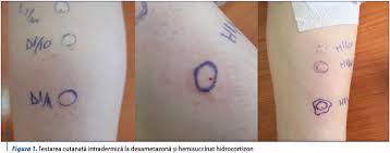 + 4 0757 117 259 fax: ReacÅ£ie De Hipersensibilitate La Hidrocortizon Hemisuccinat Cu ToleranÅ£Ä La AlÅ£i Corticosteroizi