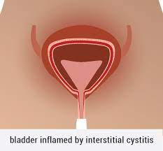 Interstitial Cystitis Madison Area Lyme Support Group