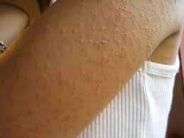 As the laser makes contact with your skin, the heat from the light will kill hair follicles. A Dermatologist S Tips For Managing Keratosis Pilaris Kp Skincare Physicians