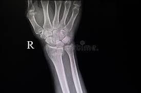 Maybe you would like to learn more about one of these? Xray Film Of Fracture Wrist Bones Stock Image Image Of Operation Diagnosis 153846289