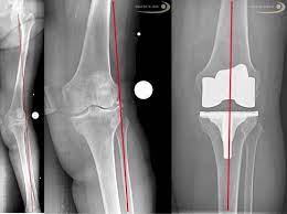 Knieendoprothese Knie Tep Kunstliches Kniegelenk Bei Kniearthrose Gelenk Klinik De