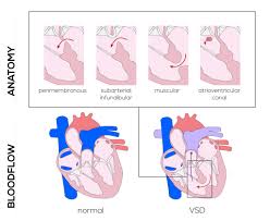 Image result for Ventricular Septal Defect