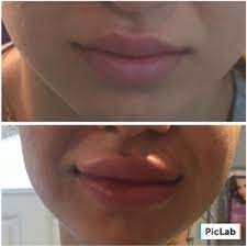 See what your friends are saying about dolce aesthetics brooklyn. Dolce Aesthetics 140 Photos 105 Reviews Medical Spas 8721 3rd Ave Brooklyn Ny Phone Number Yelp