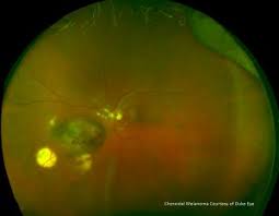 Retinal tear temporal about 4 o'clock in the left eye. Daytona Optos Retinal Imaging Camera
