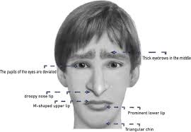 Mowat-Wilson syndrome: unraveling the complexities of diagnosis, treatment,  and symptom management