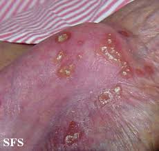 Arthritis is when joints become inflamed and painful. Reactive Arthritis Physical Examination Wikidoc