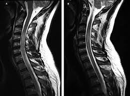 Atm comprises a subgroup of the noncompressive transverse myelopathies. A Case Of Longitudinally Extensive Transverse Myelitis Following Vaccination Against Covid 19 Sciencedirect