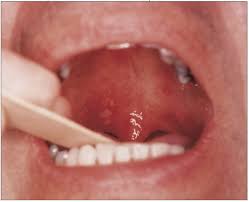 A clear look at the white sore in mouth, inside the lip, cheek, on gum, back of throat, std, home e remedy, how to get rid and the treatments. Punctate Oral Erosions Self Limited Sore Or Something More Serious Consultant360