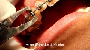 Some people spend relatively short there has been much speculation, but little evidence, on how durable any immunity is. Bracket Removal Taking Off Braces Removing Orthodontic Brackets By Dr Amr Asker Youtube