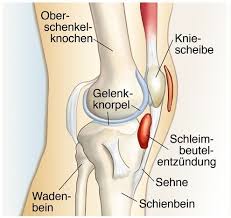 Schleimbeutelentzundung Knie Schmerzhaftes Uberlastungszeichen