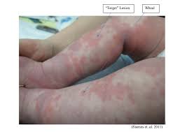 Image result for Erythema Multiforme Causes