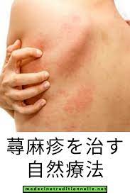 蕁麻疹を治す自然療法 自然療法 蕁麻疹 バレリアン