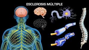 Esclerosis Multiple Esclerosis Multiple Esclerosis Esclerosis Multiple Diagnostico