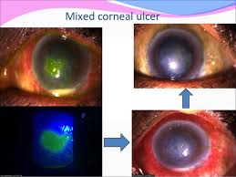 Primary infection typically presents as swelling of the conjunctiva and eyelids (blepharoconjunctivitis), accompanied by small white itchy lesions. Herpes Simplex Keratitis Herpes Zoster Opthalmicus