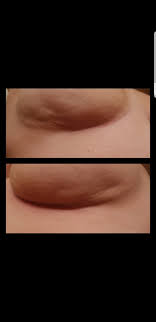 Dimpling of the skin can be related to breast cancer in a number of ways. I Just Read About How Dimples Are A Sign Of Breast Cancer Ive Had Them For A While And Never Really Thought About It Should I Be Concerned Top Right Bottom Left