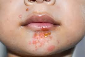 Image result for Impetigo