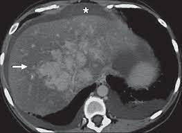 Axial Contrast Enhanced Ct Scan Of Abdomen Of 30 Year Old Woman With Download Scientific Diagram