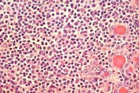 Image result for Thyroiditis