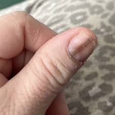 Image result for Acral lentiginous melanoma nail