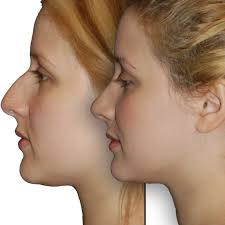 There is a chance your insurance will cover your procedure, at least in part. Best Rhinoplasty In Beverly Hills Ca Nose Job Surgery Dr Jason Diamond