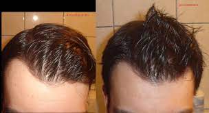 ✅ click here to learn more! Maystor S Story Hairlosstalk Forums