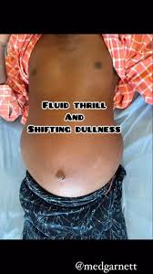 Image result for Shifting Dullness Test