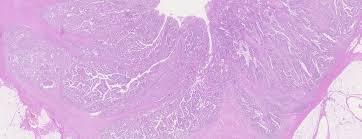 Adjuvant chemotherapy in stage iii colon cancer is standard of care. Le Cancer Colorectal Forum Medical Suisse