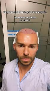 Discover the Truth About Hair Transplants