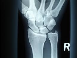 Tfcc injuries in children and adolescents occur more often after an ulnar styloid fracture. Ellenseitiger Handgelenksschmerz