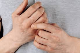 Image result for Neurodermatitis